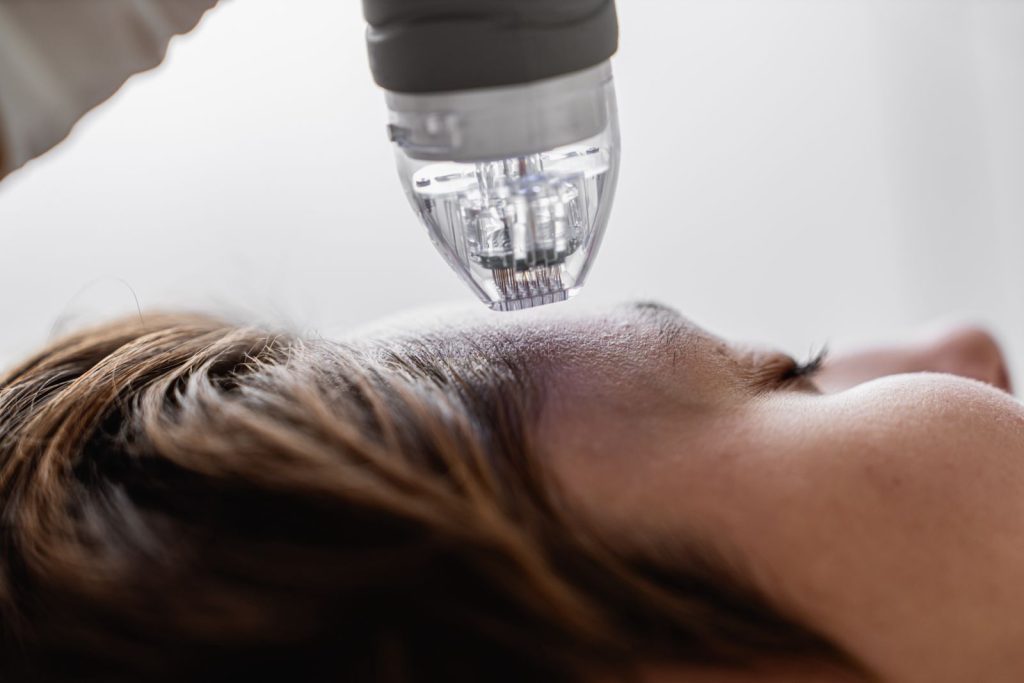 Microneedling Gesichtsbehandlung in Berlin Dahlem bei Skinlifter