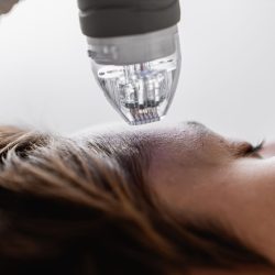 Microneedling Gesichtsbehandlung in Berlin Dahlem bei Skinlifter